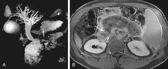 Dilated Bile Ducts Radiology Key