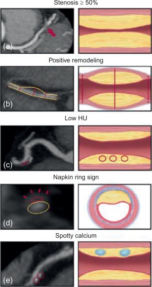 Various Types of Plaques