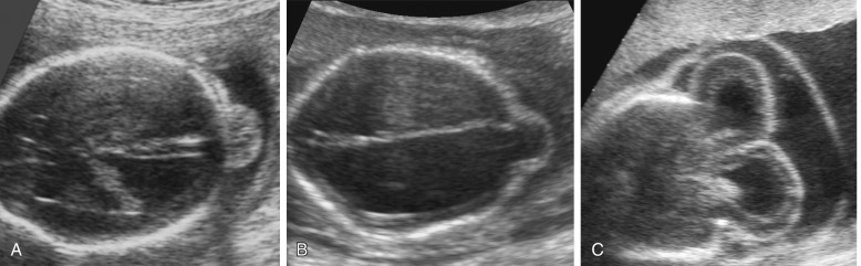 Ultrasound Evaluation Of The Fetal Central Nervous System Radiology Key 