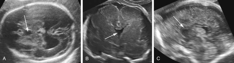 Ultrasound Evaluation Of The Fetal Central Nervous System Radiology Key 