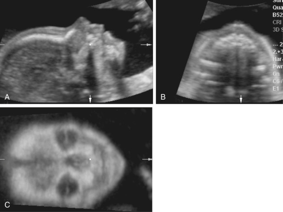 Ultrasound Evaluation Of The Fetal Face And Neck Radiology Key