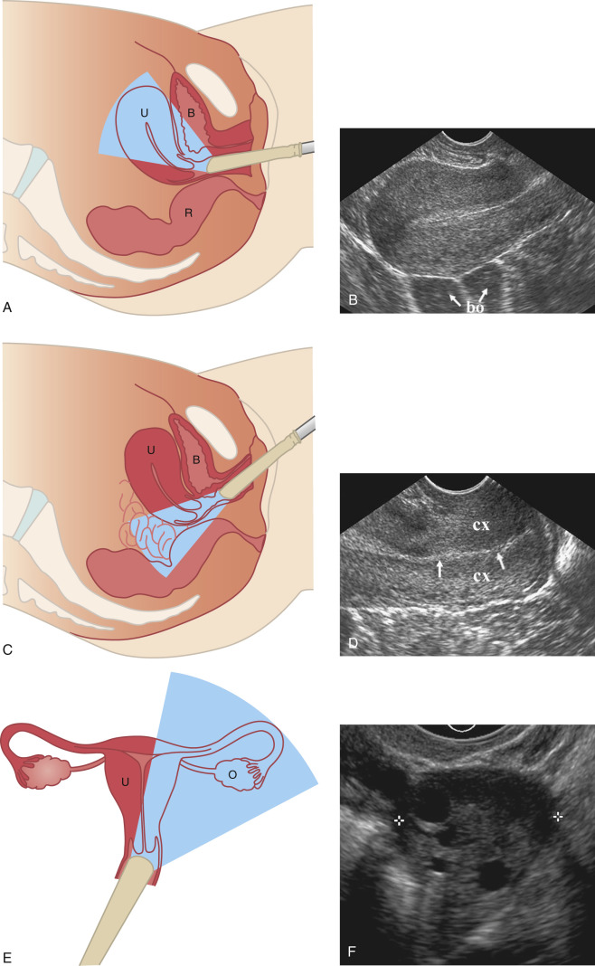 Normal Anatomy Of The Female Pelvis And Transvaginal Sonography