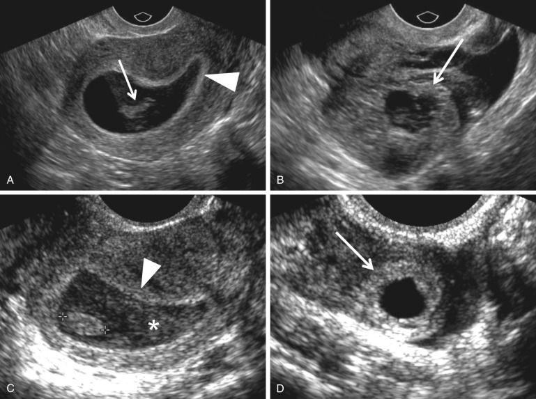 ectopic pregnancy ultrasound ring of fire