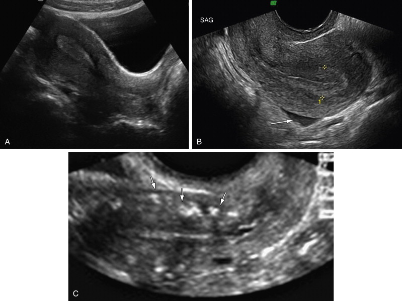 6 ultrasound tilted weeks uterus Pregnancy: 8