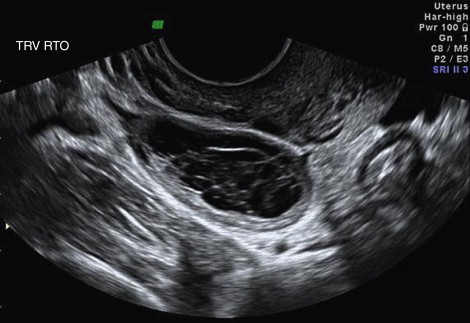 Tilted uterus ultrasound 6 weeks