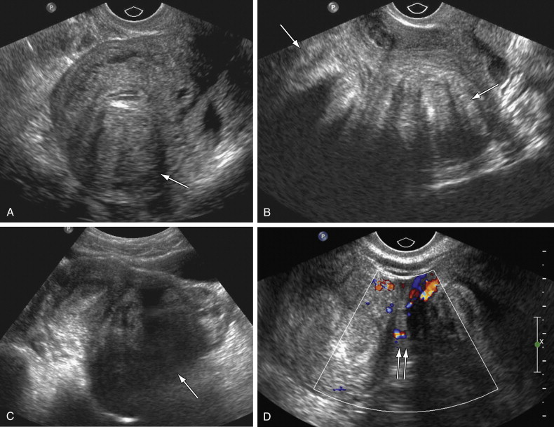 Chronic Pelvic Pain