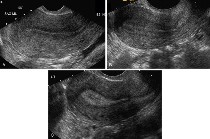 Benign Endometrial Causes Of Abnormal Bleeding Radiology Key 