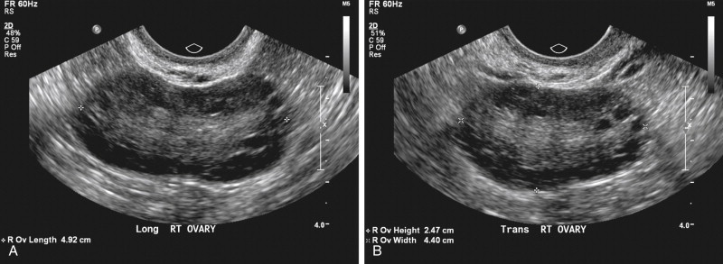 normal vs polycystic ovaries ultrasound