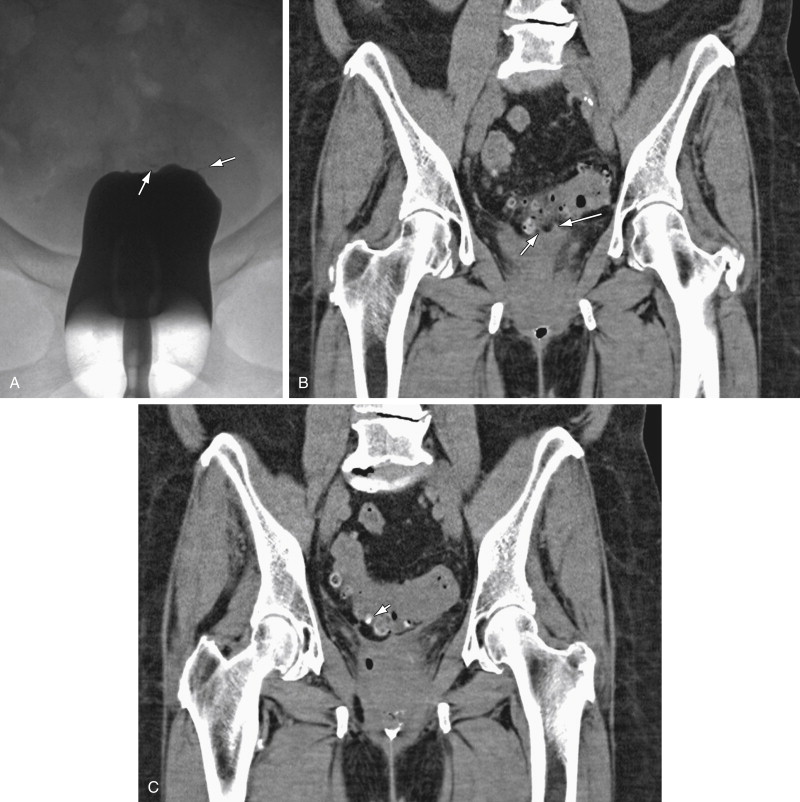 Vaginal Fistulas Radiology Key Hot Sex Picture