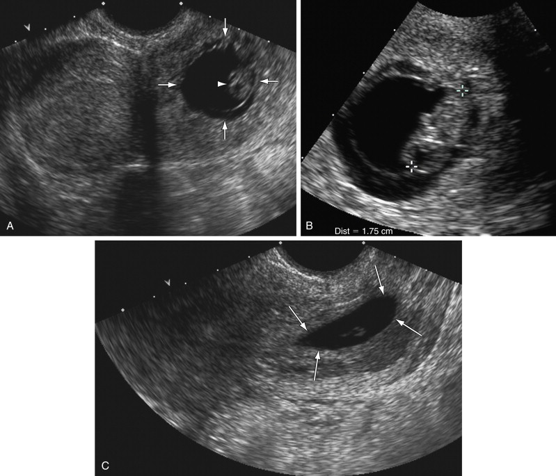 cervical ectopic pregnancy