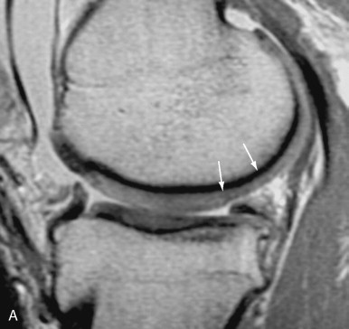 Magnetic Resonance Imaging Of Articular Cartilage | Radiology Key