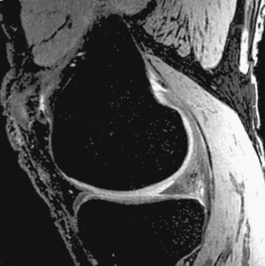 Magnetic Resonance Imaging Of Articular Cartilage | Radiology Key