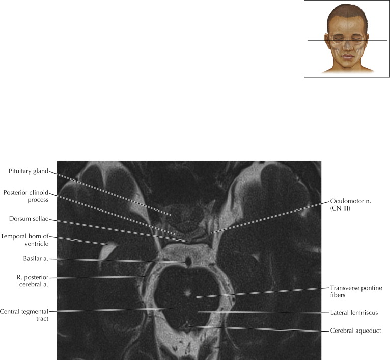 Brainstem And Cranial Nerves Radiology Key