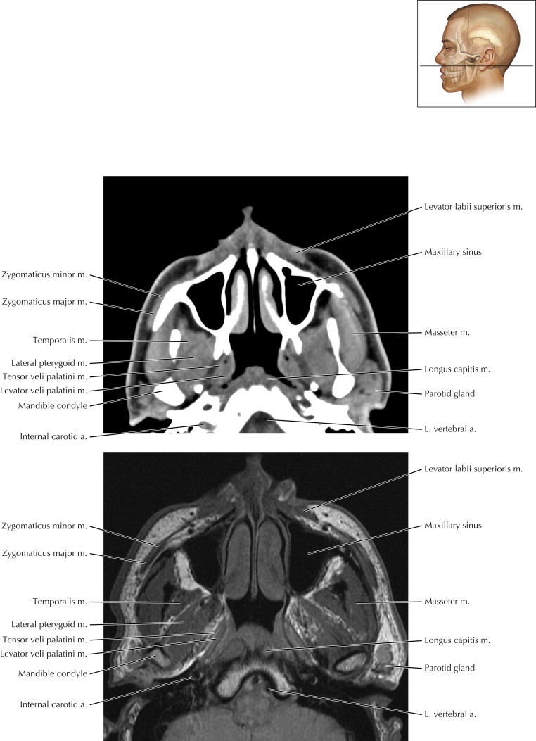 Mandible and Muscles of Mastication | Radiology Key