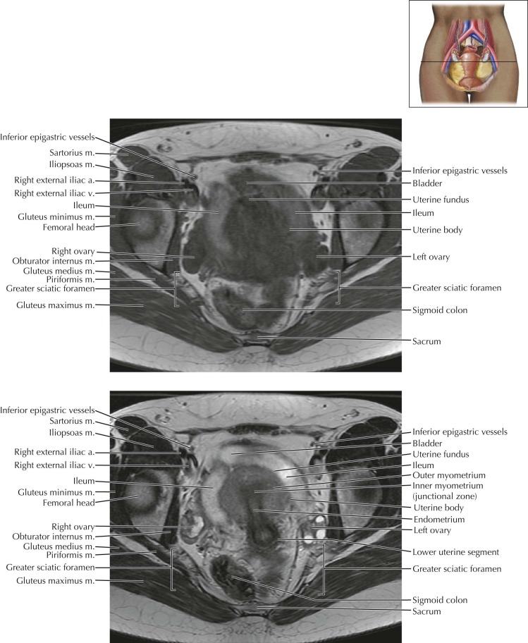 Female Pelvis | Radiology Key