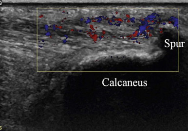 Calcaneal sale spur ultrasound