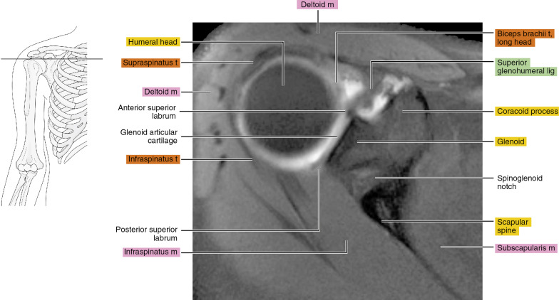 Mr Arthrography Of The Shoulder Radiology Key