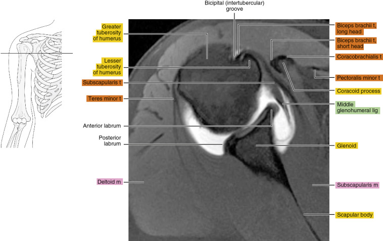 Mr Arthrography Of The Shoulder Radiology Key