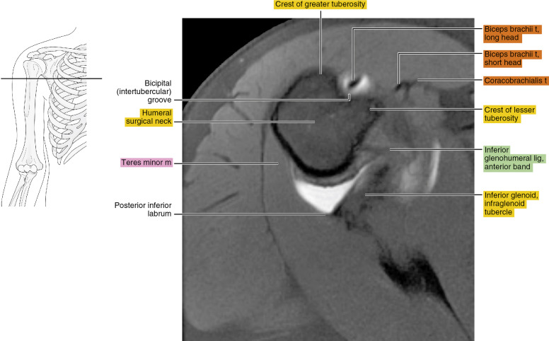 MR arthrography of the shoulder | Radiology Key
