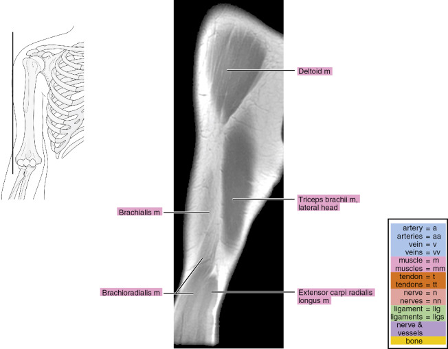 MRI of the arm | Radiology Key