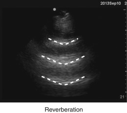 Imaging Artifacts | Radiology Key