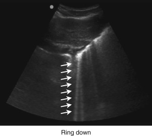 Imaging Artifacts | Radiology Key