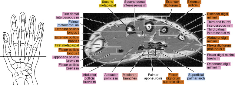 MRI Of The Hand Radiology Key