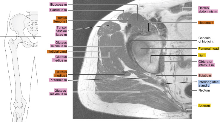 Gluteal muscles, Radiology Reference Article