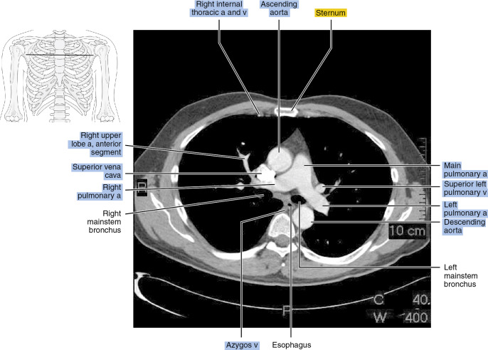 ct-of-the-thorax-radiology-key