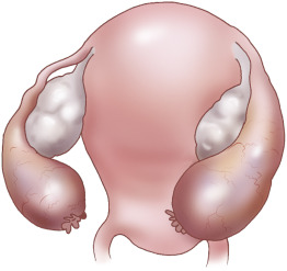 Pathology of the adnexa | Radiology Key