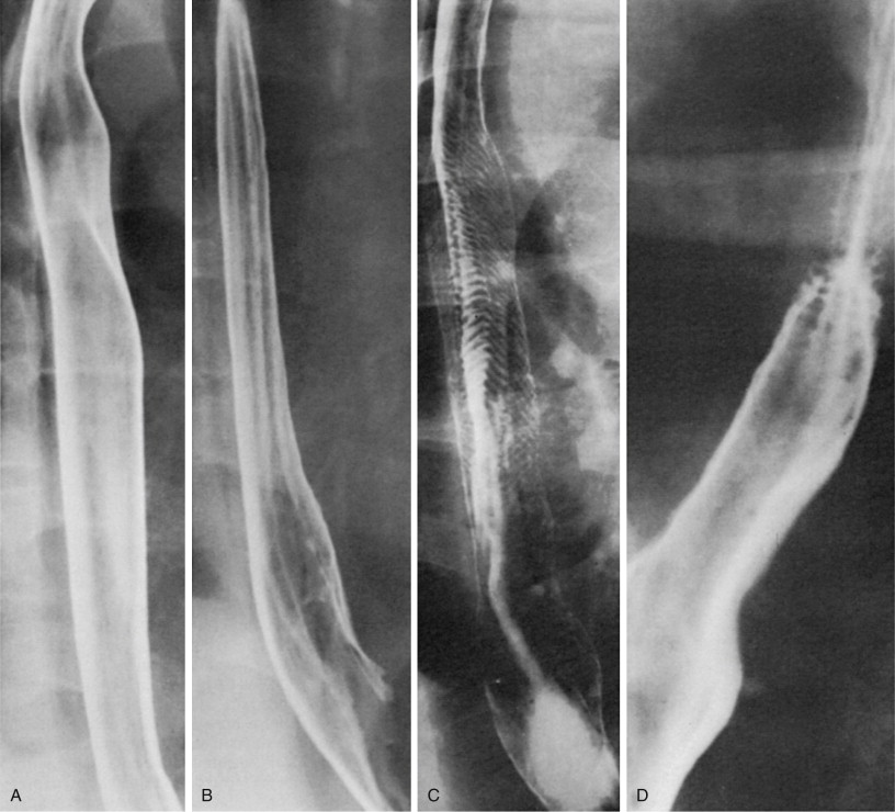 Barium Studies Of The Upper Gastrointestinal Tract | Radiology Key