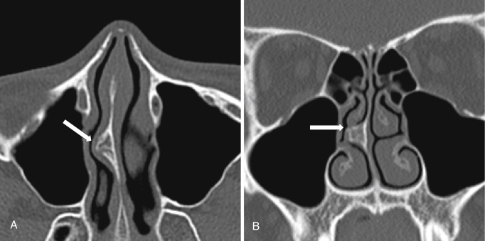 Imaging Of The Paranasal Sinuses And Their Surgical Relevance 