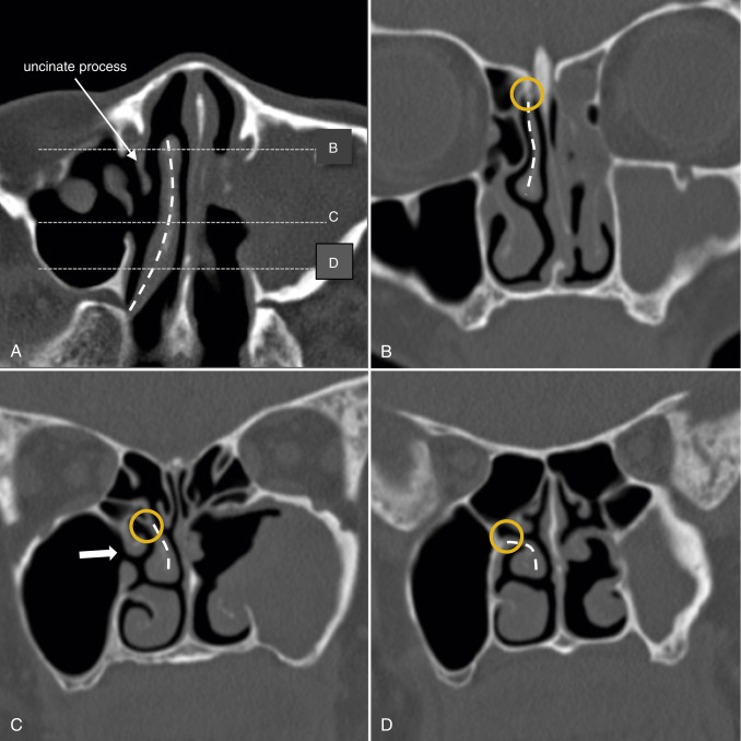 Imaging Of The Paranasal Sinuses And Their Surgical Relevance Radiology Key 0669