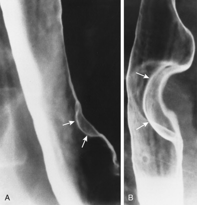 Benign Tumors Of The Esophagus Radiology Key