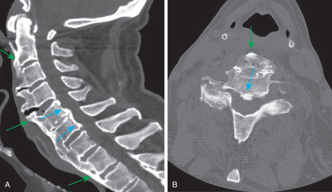 Ossification Of The Posterior Longitudinal Ligament Radiology Key