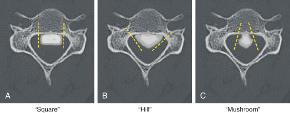 Ossification Of The Posterior Longitudinal Ligament Radiology Key