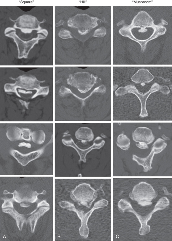 Ossification of the Posterior Longitudinal Ligament | Radiology Key