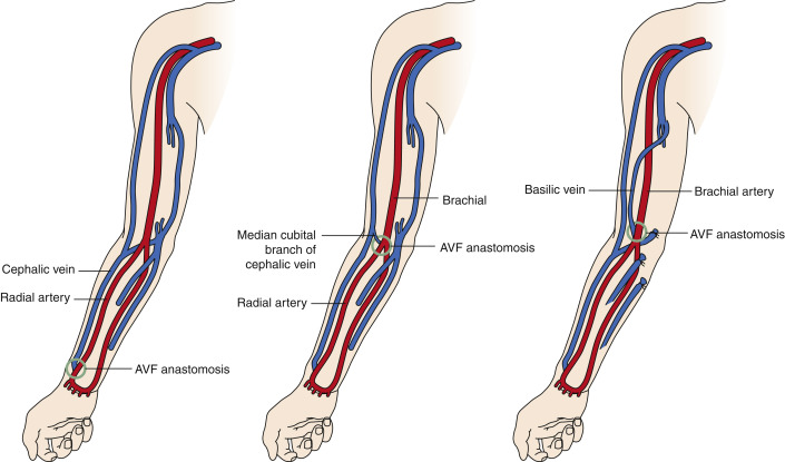 fistula for dialysis placement