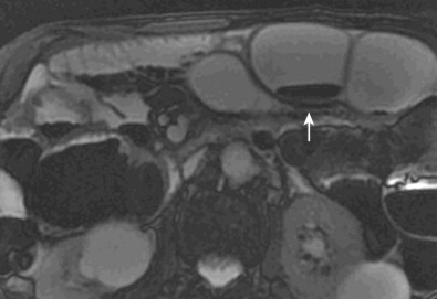 Magnetic Resonance Enterography Radiology Key