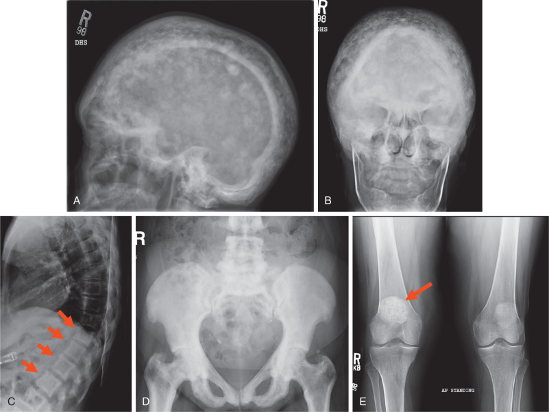 Pagets Disease Radiology Key 4715