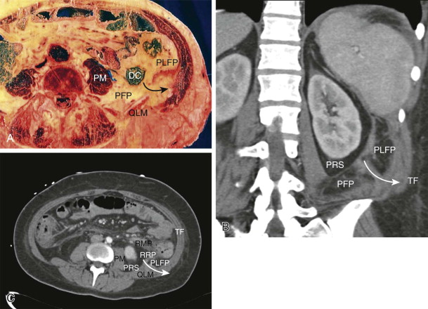 Anatomy And Imaging Of The Peritoneum And Retroperitoneum Radiology Key