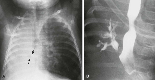 Diseases Of The Pediatric Esophagus Radiology Key 6423