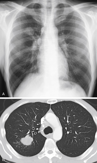 solitary-pulmonary-nodule-radiology-key