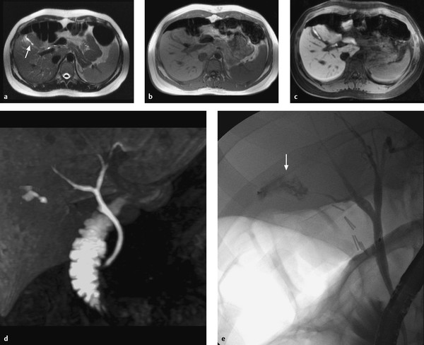 Liver Anatomy Radiology