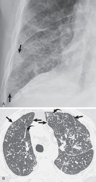 Niemann-Pick. HRCT at the level of the lower lobes shows intense and