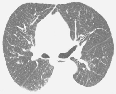 Niemann-Pick. HRCT at the level of the lower lobes shows intense and