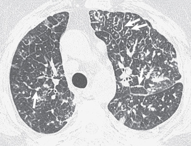 Niemann-Pick. HRCT at the level of the lower lobes shows intense and