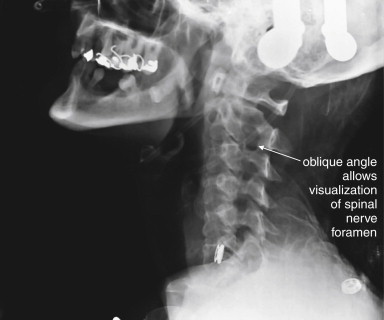 Cervical Spine Pathology, Radiology