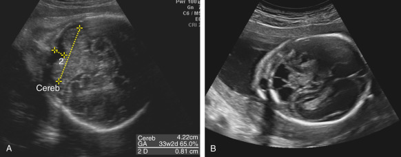 Normal Range Fetal Cerebellum Measurement Chart 