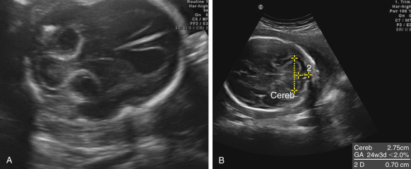 cerebellar vermis ultrasound